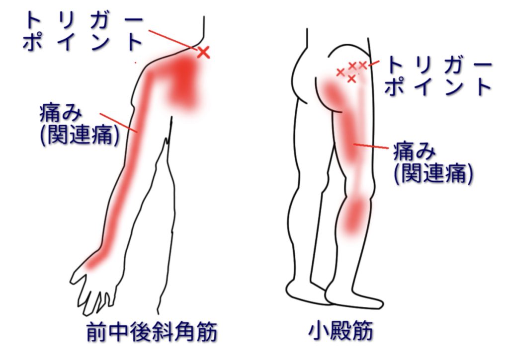 トリガーポイント